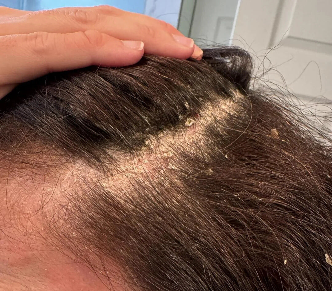 It Wasn’t Just Flakes… It was Everything They Stole From me.